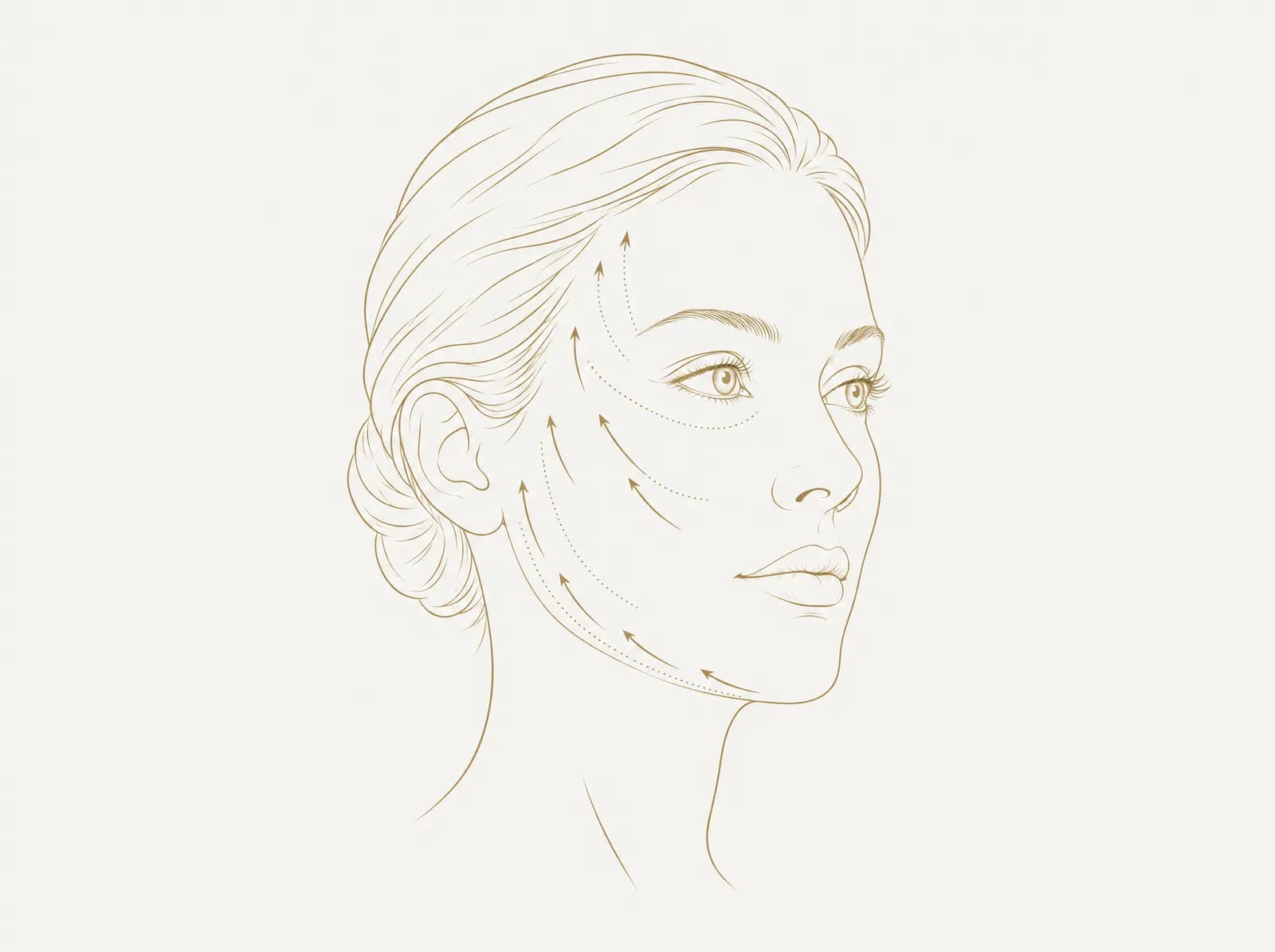رسم خطي لوجه بزاوية ثلاثة أرباع، مع أسهم تُظهر الشد إلى الأعلى على امتداد الفك والخد