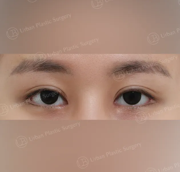 Inner corner reversal, After, Front, Case 3AkvM