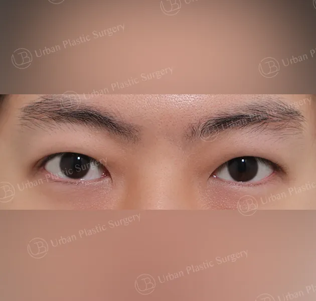 Suture double eyelid, After, Front