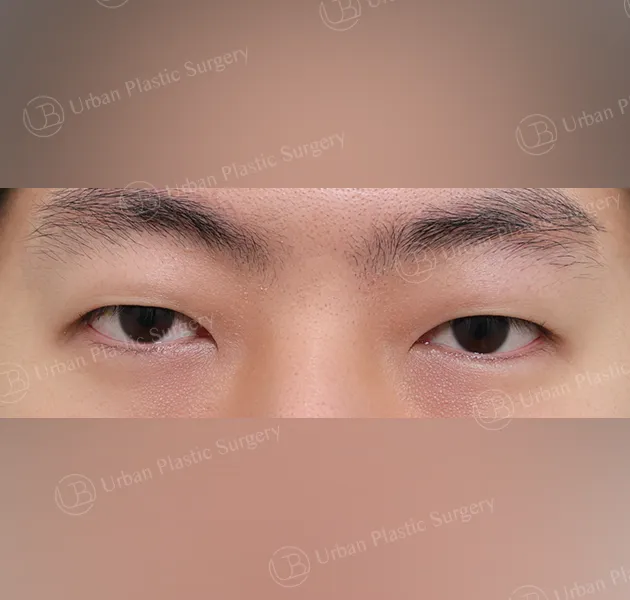 Suture double eyelid, Before, Front