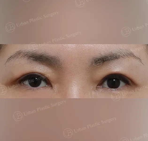 Upper blepharoplasty, After, Front