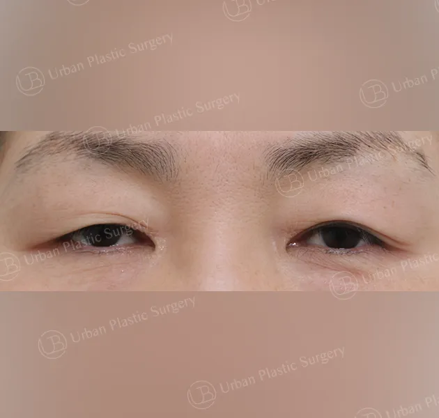 Upper blepharoplasty, Before, Front