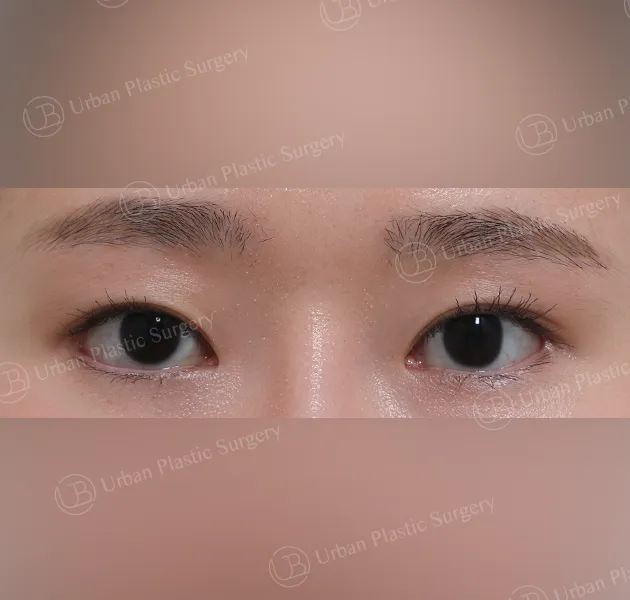 Dual canthoplasty, After, Front
