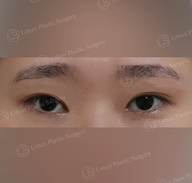 Dual canthoplasty, Before, Front