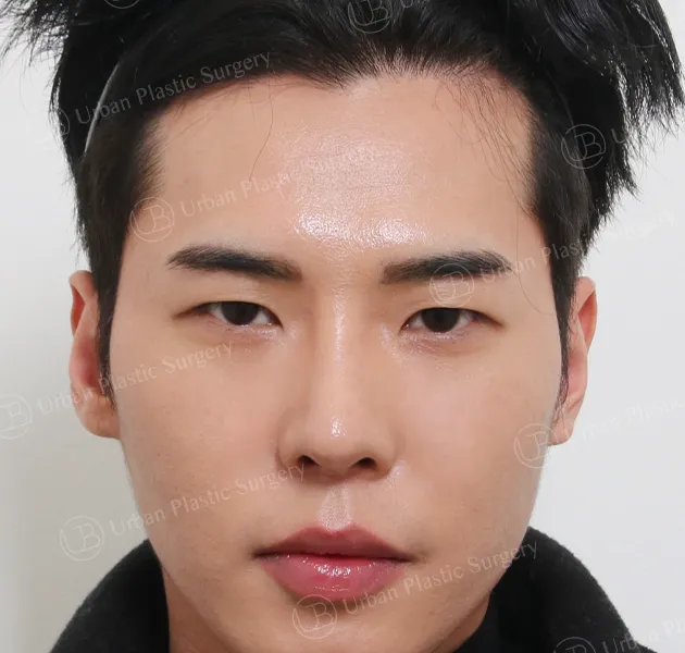 แก้กล้ามเนื้อตาอ่อนแรงแบบไม่กรีด หลัง ด้านหน้า
