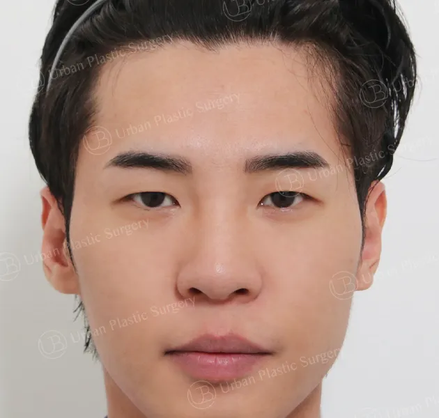 แก้กล้ามเนื้อตาอ่อนแรงแบบไม่กรีด ก่อน ด้านหน้า