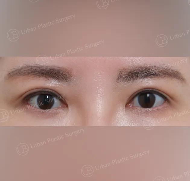 Non-incisional ptosis correction, After, Front