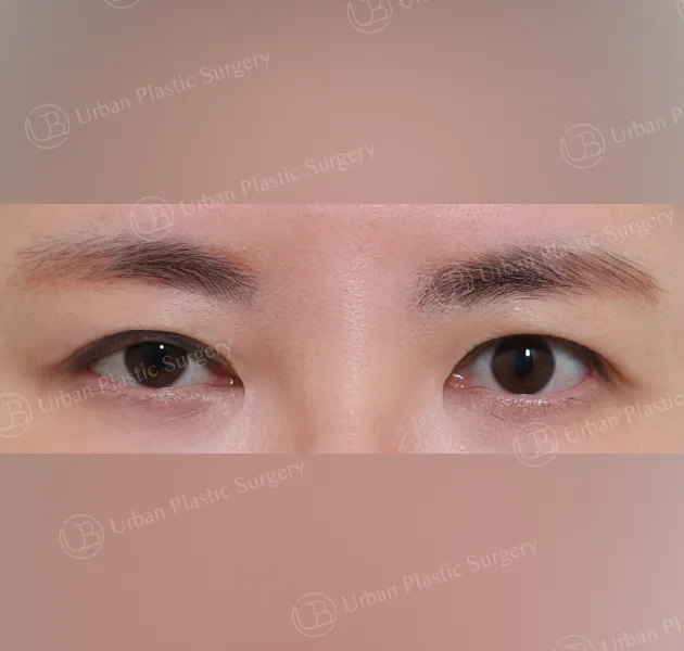 Non-incisional ptosis correction, Before, Front