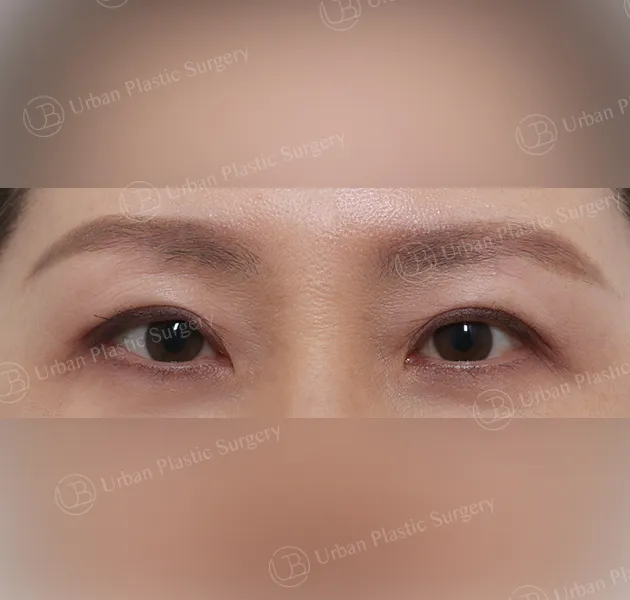 Suture double eyelid, After, Front, Case 6LyWw