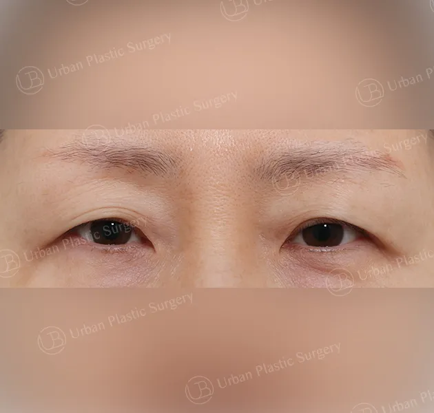 Suture double eyelid, Before, Front, Case 6LyWw