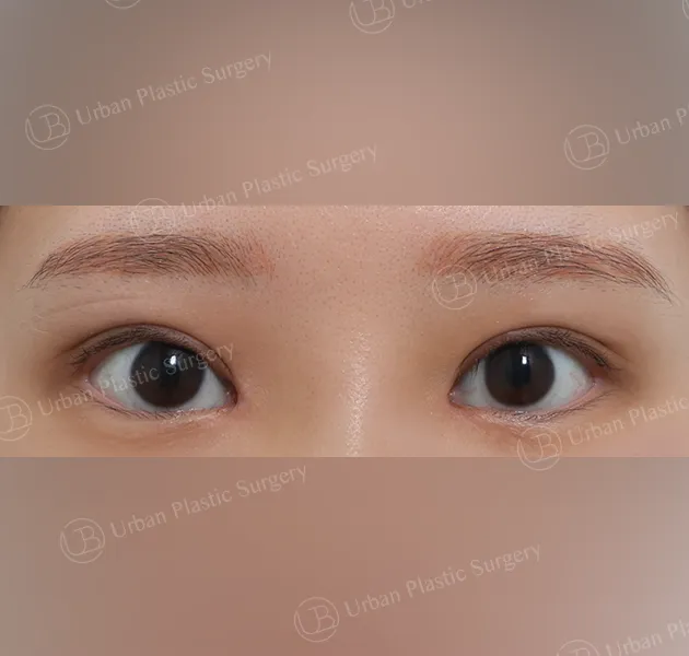 Inner corner reversal, After, Front, Case 6cg3x