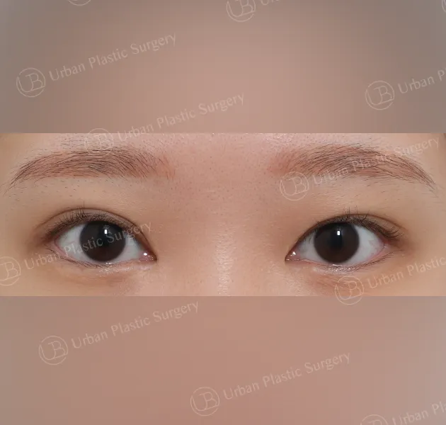 Inner corner reversal, Before, Front, Case 6cg3x