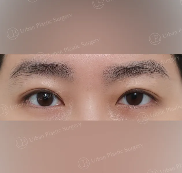 Non-incisional ptosis correction, After, Front