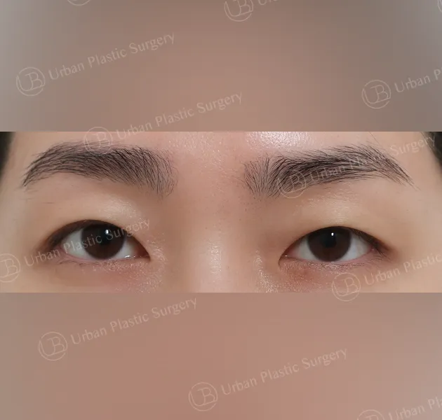 Non-incisional ptosis correction, Before, Front