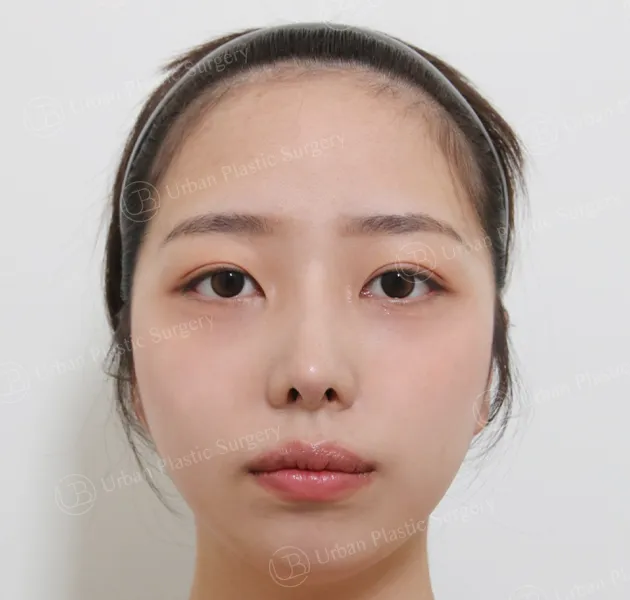 Eye revision, After, Front