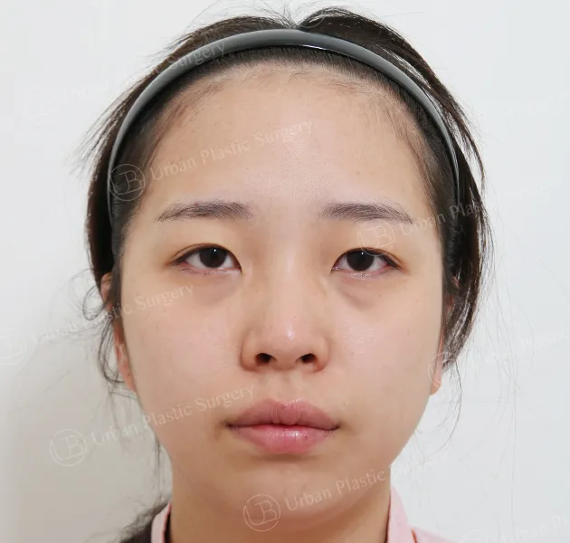 Eye revision, Before, Front