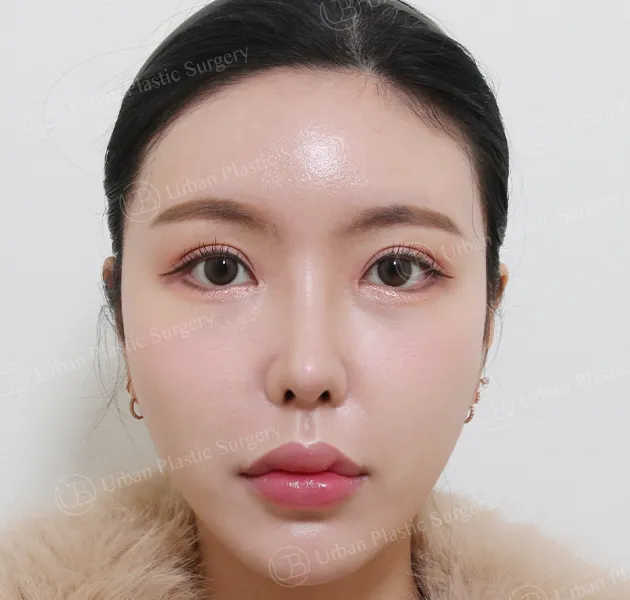 鼻子重修,術後,正面,案例 8PeiK