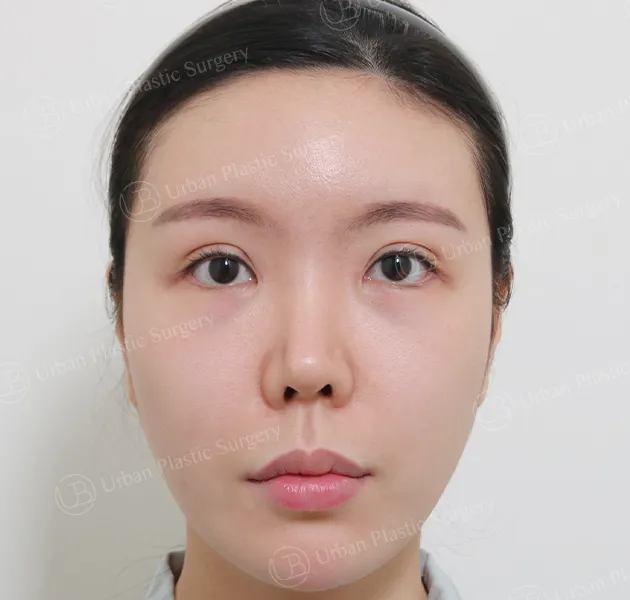 鼻子重修,術前,正面,案例 8PeiK
