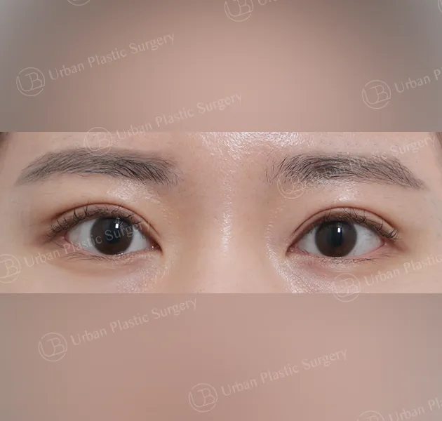 Suture double eyelid, After, Front
