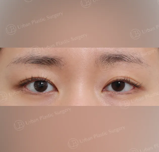 Suture double eyelid, Before, Front