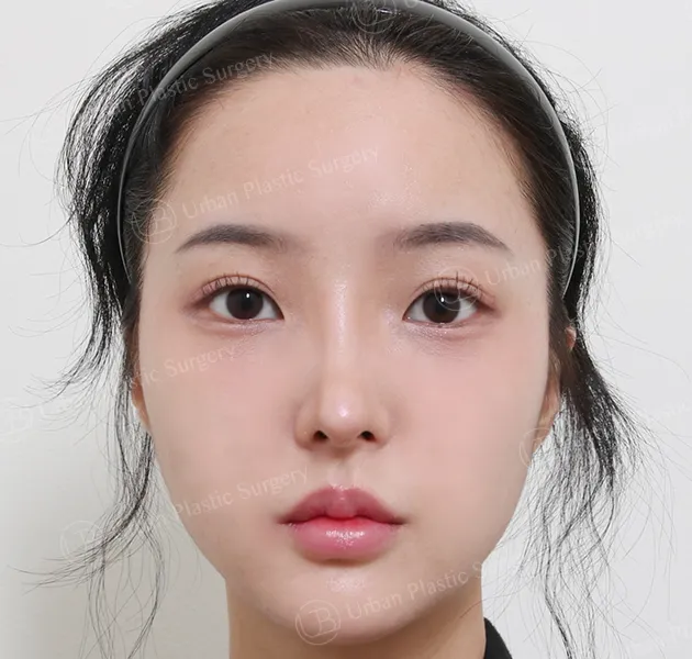 Rhinoplasty, After, Front