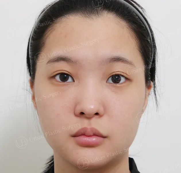 Rhinoplasty, Before, Front