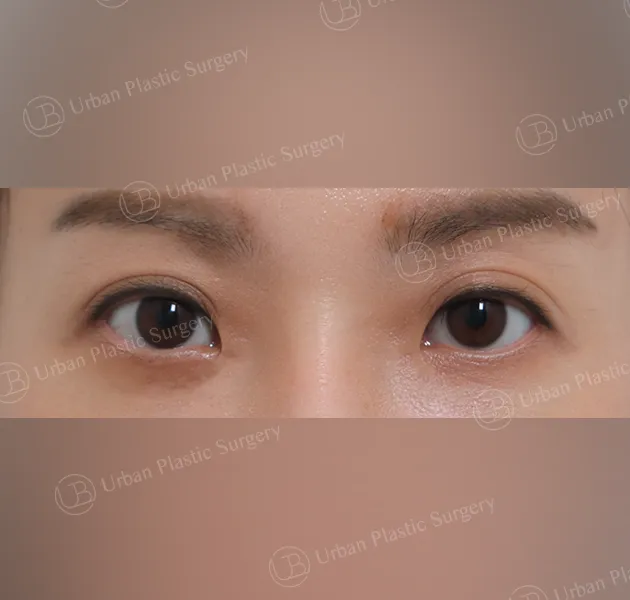 Under-eye fat repositioning, After, Front