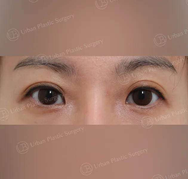 Under-eye fat repositioning, Before, Front