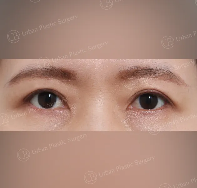 Sub-brow lift, After, Front