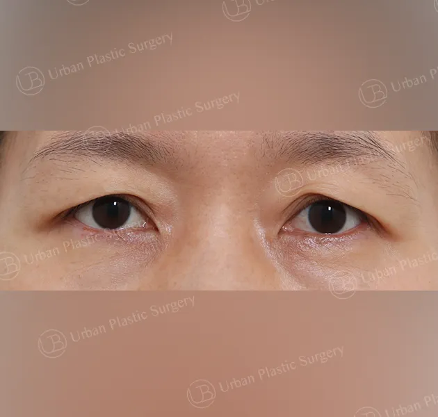 Sub-brow lift, Before, Front