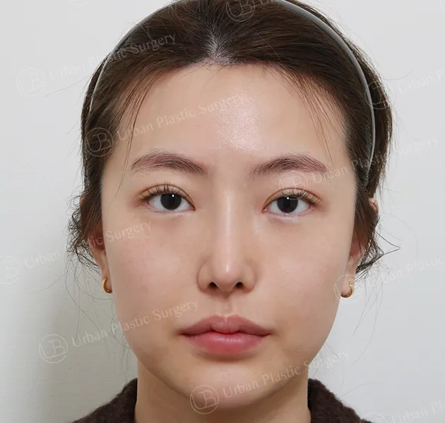 Forehead reduction, After, Front