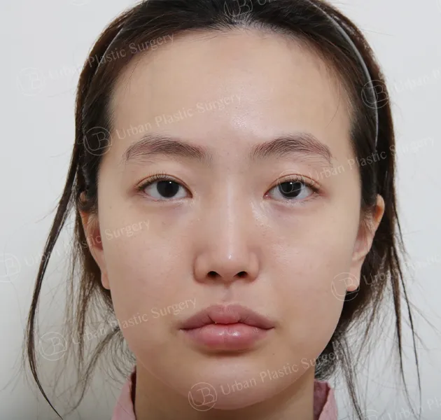 Forehead reduction, Before, Front