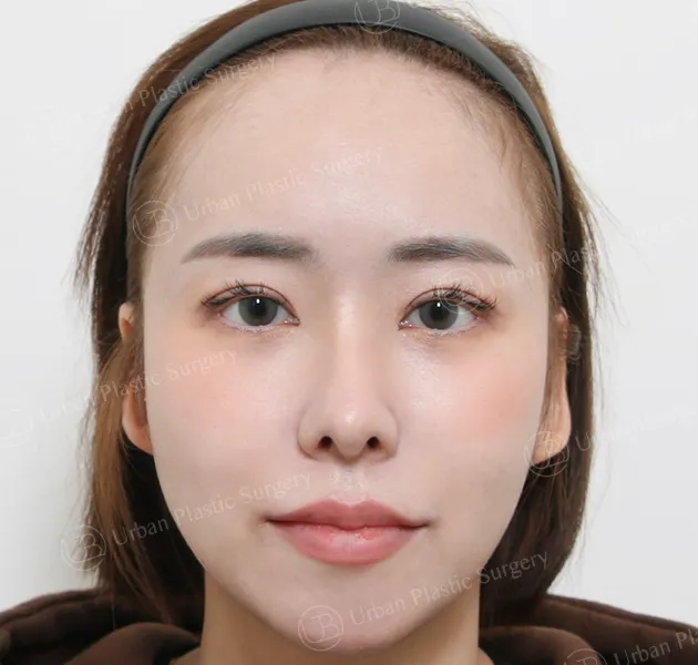Eye revision, After, Front