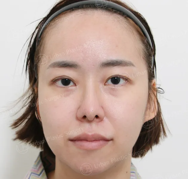 Eye revision, Before, Front