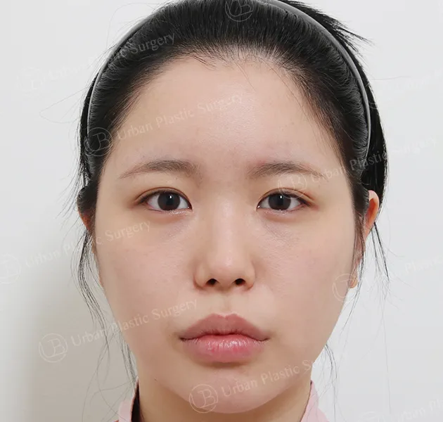 Eyes, Before, Front
