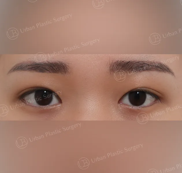 Four-way canthoplasty, After, Front