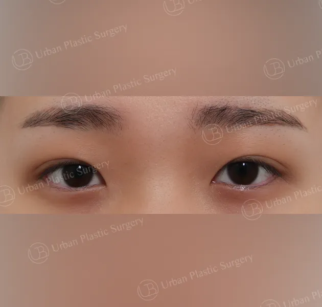 Four-way canthoplasty, Before, Front
