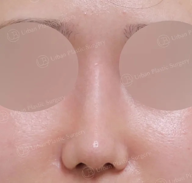 Rhinoplasty, After, Front