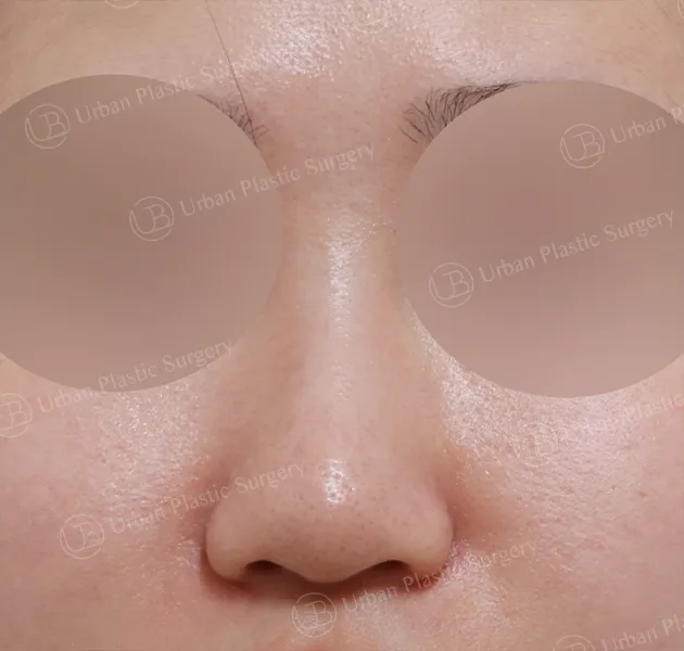 Rhinoplasty, Before, Front