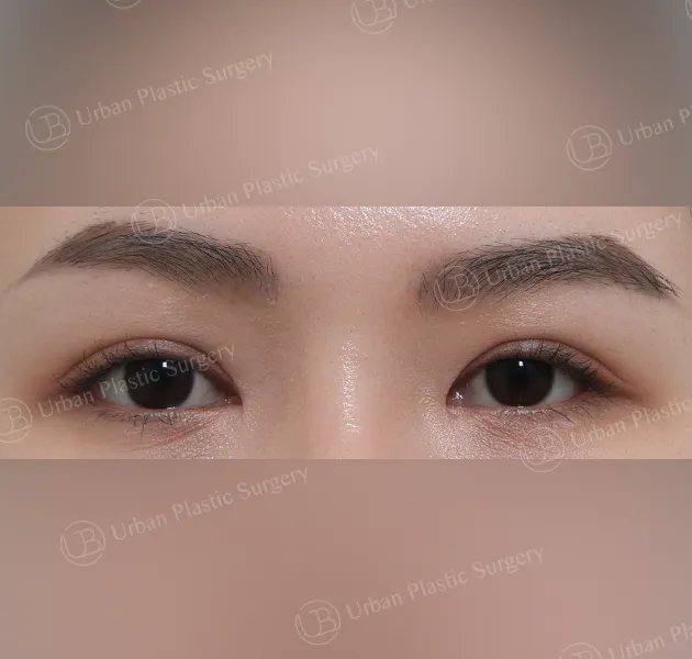 Incisional ptosis correction, After, Front