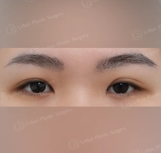 Incisional ptosis correction, Before, Front