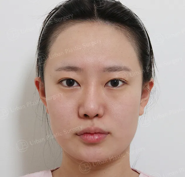 抗老，術前，正面，案例 DfN3B