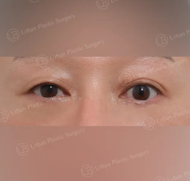 Under-eye fat repositioning, After, Front