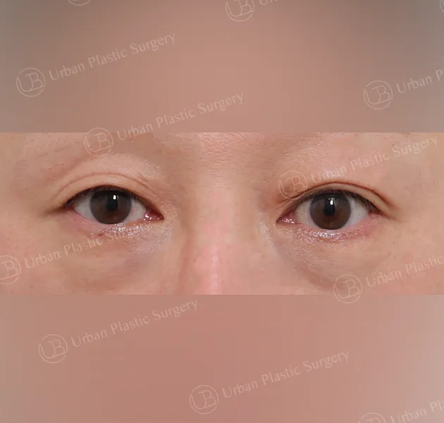 Under-eye fat repositioning, Before, Front