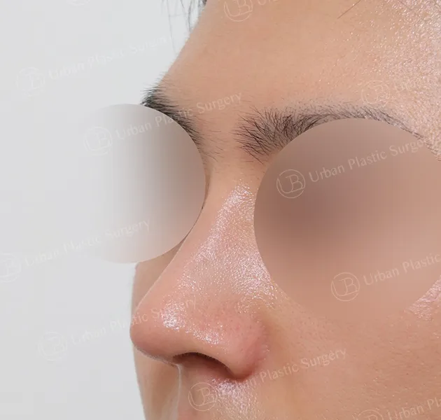 Implant-free rhinoplasty, After, 45°