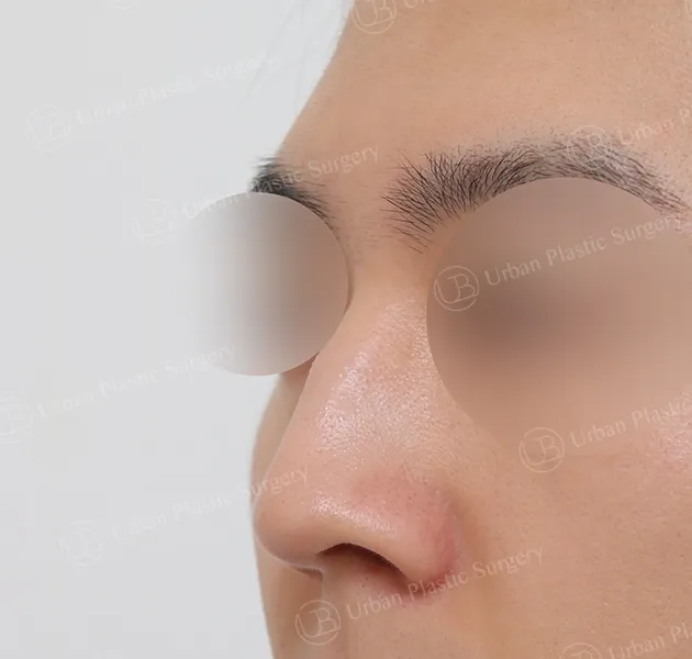Implant-free rhinoplasty, Before, 45°