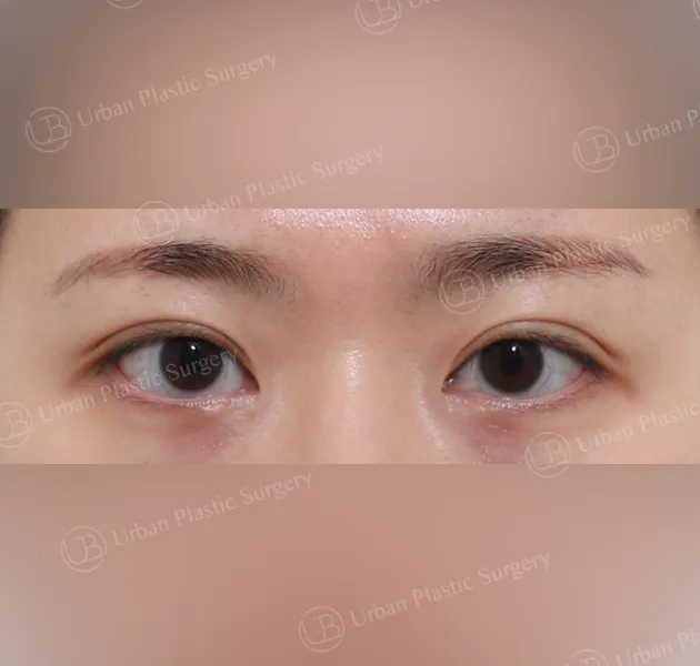 Suture double eyelid, After, Front, Case GtExg