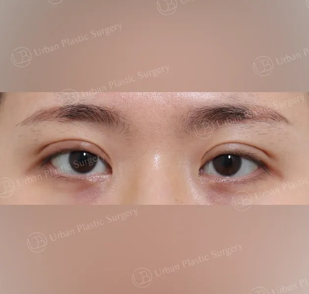 Suture double eyelid, Before, Front, Case GtExg