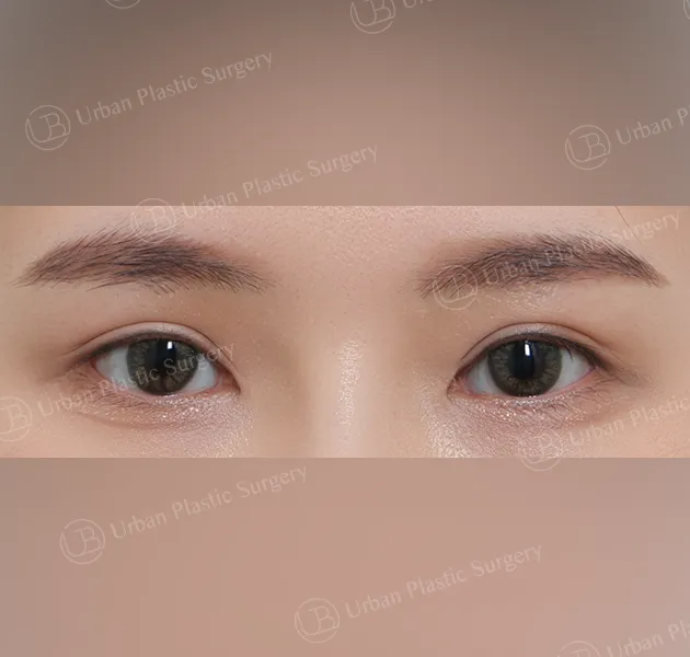Incisional ptosis correction, After, Front