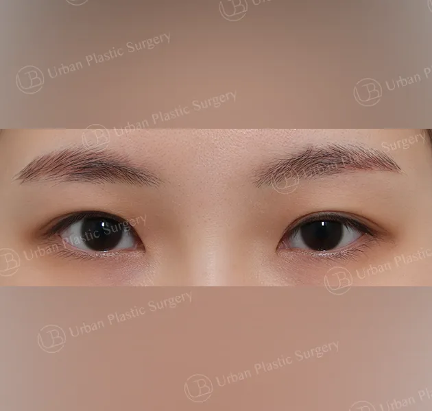 Incisional ptosis correction, Before, Front